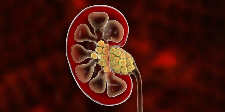  علت سنگ کلیه چیست و چرا دچار آن می‌شویم؟